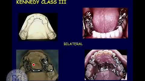 DENT 718  Classification and components of removable partial dentures