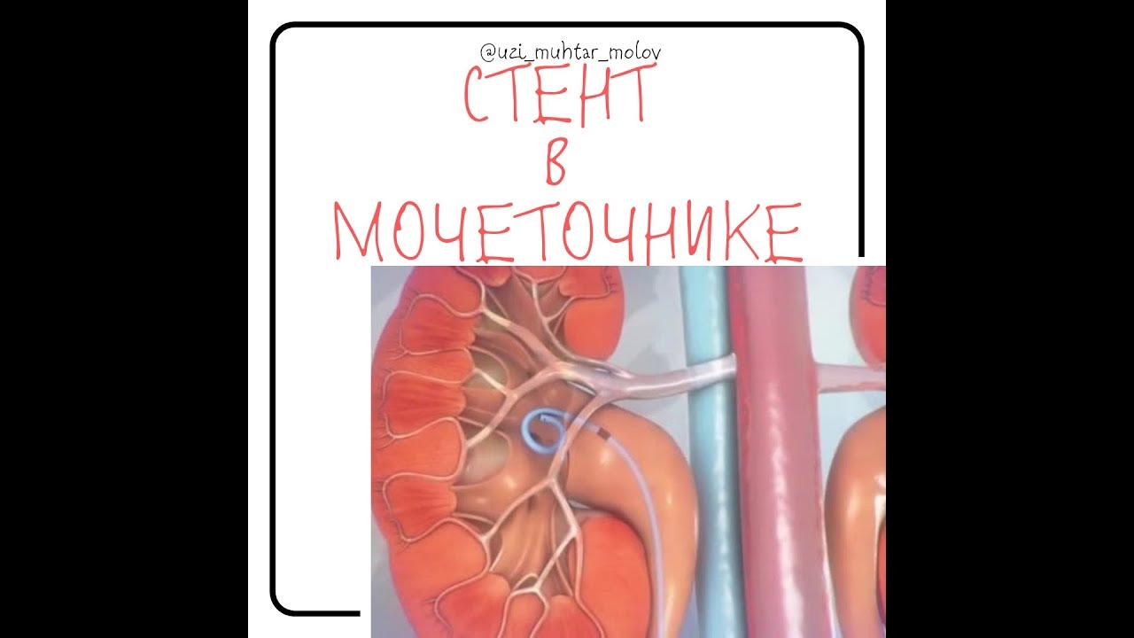 Стент в почке на УЗИ почек и мочевого пузыря - YouTube