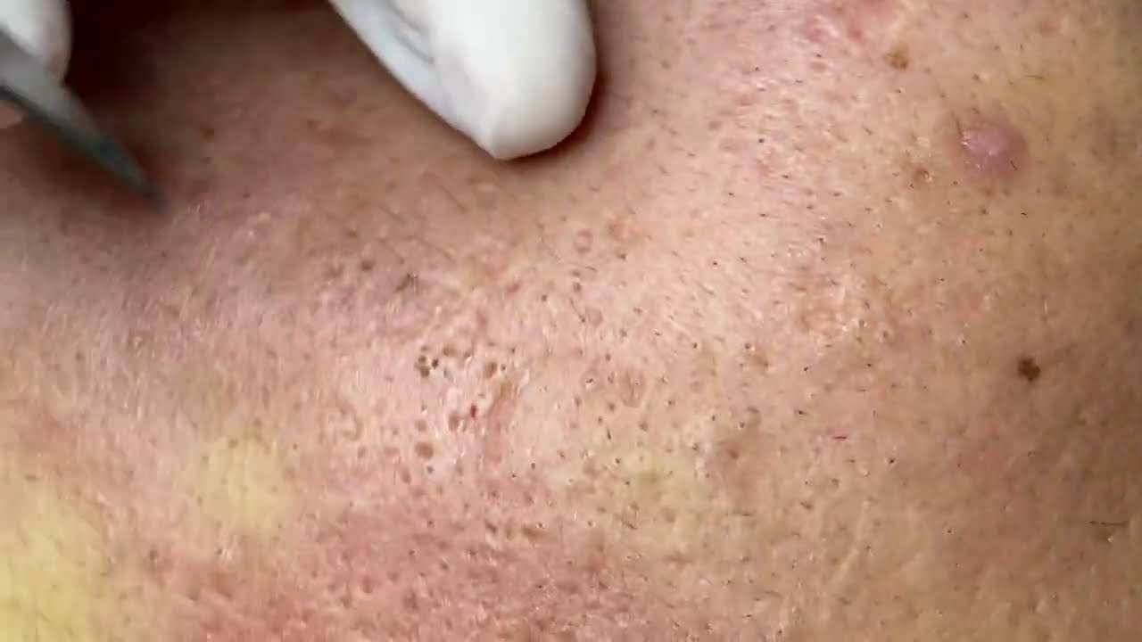 Acne Treatment | Điều Trị Mụn Ẩn - ThuyTruong#65