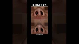비공내리기 붓기빠지는 과정