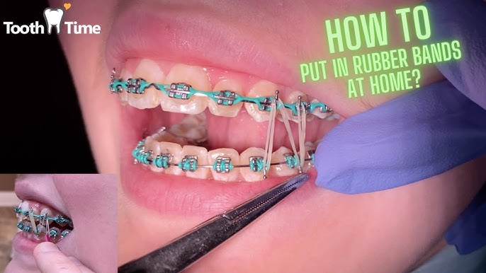 Elastics for Braces – Everything You Need to Know - Stoll