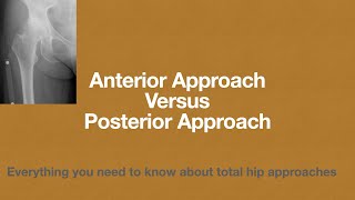 DIRECT ANTERIOR vs POSTERIOR approach to the hip l Total Hip Replacement lon-table vs off-table /DAA