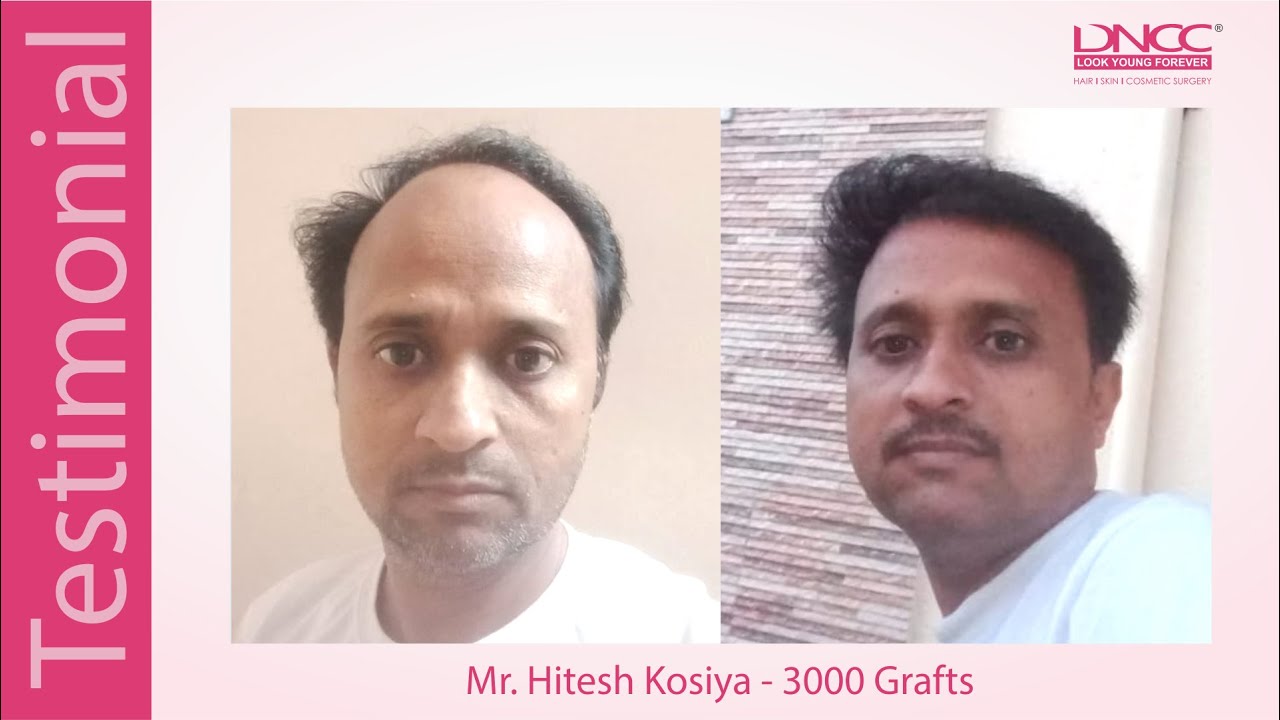 Discover 70+ hair transplant in rajkot best in.eteachers