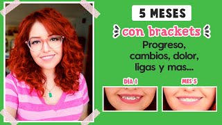 5 MESES CON BRACKETS 😁 | PROGRESO, DOLOR, TIPS | MI EXPERIENCIA | Mirem Itziar ❤