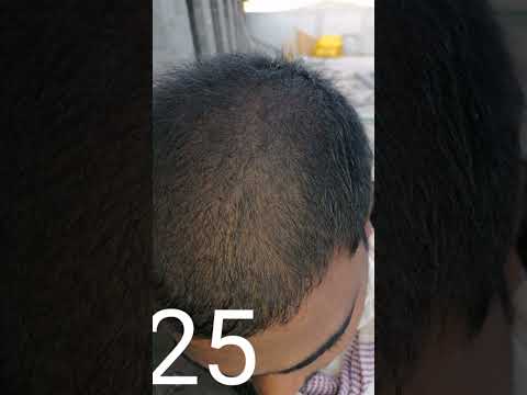 Neo Hair Lotion