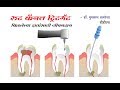 रूट कॅनल ट्रिटमेंट (Root Canal Treatment) in Hindi