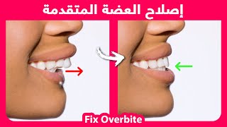 How to naturally fix an overbite | كيفية إصلاح العضة المتقدمة بشكل طبيعي