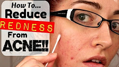 HOW TO: REMOVE REDNESS FROM ACNE & SCARRING! *REQUESTED!*