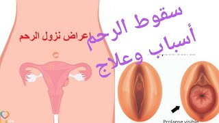 السقوط الرحمى (uterine prolapse) أسباب ,أعراض,علاج