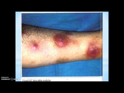 Video: Psí paniculitis