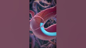 Flow Diverter Stent Delivery Process