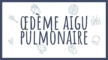 Comment detecter un œdème pulmonaire ?