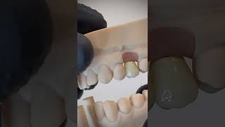 Corona singola su impianto dentale (simulazione su modello) dentist dentista dentalimplant dente