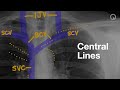 Central Lines on CXR