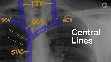 Central Lines on CXR