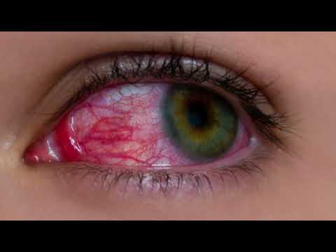 Eye Redness - EXPLAINED! | Dr. D'Orio Eyecare
