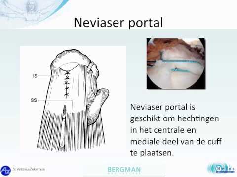De (modified) Neviaser portal bij de arthroscopische cuff repair