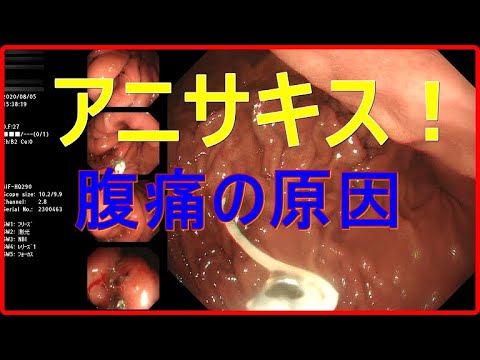 アニサキス　腹痛の原因！