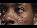 #PoreZen #BlackheadRemoval #PimplePopping #ASMRBlackhead 76