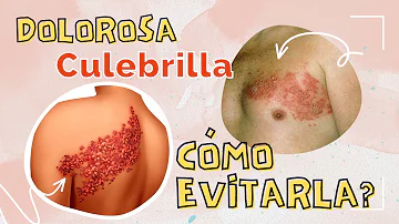 ¿Debo ir a trabajar con herpes zóster?