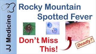 Rocky Mountain Spotted Fever | Bacteria, Signs & Symptoms, Diagnosis and Treatment