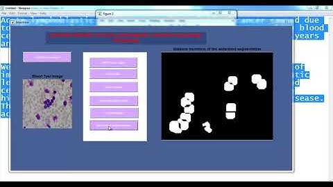 detection of leukemia using matlab code projects | detection of leukemia using matlab code thesis