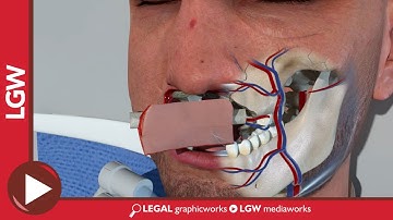 Maxilla Reconstruction Surgery Using a Fibula Flap 3D animation