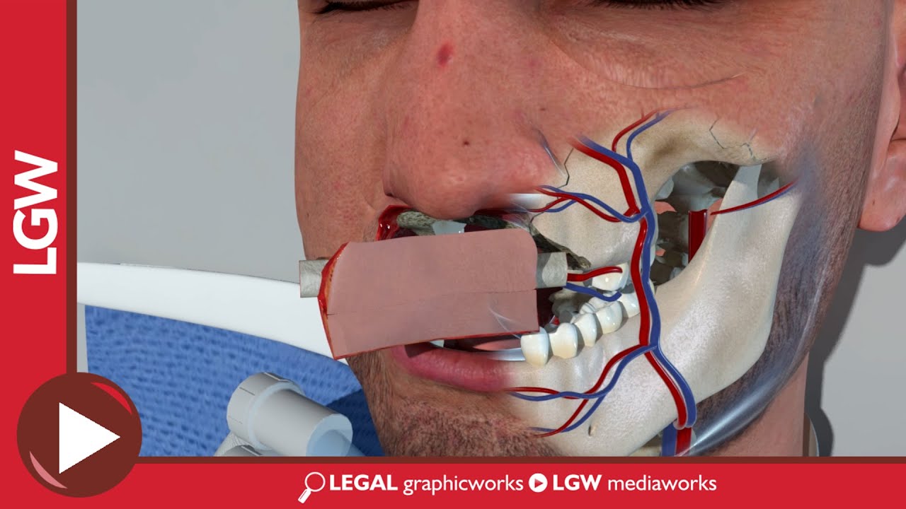 Maxilla Reconstruction Surgery Using A Fibula Flap 3D Animation YouTube Maxilla Reconstruction Surgery Using A Fibula Flap 3D Animation YouTube