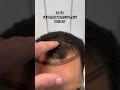 FUE HAIR TRANSPLANT PRE-OP. We’ll be sharing progress videos on this case! #hairtransplant #fue