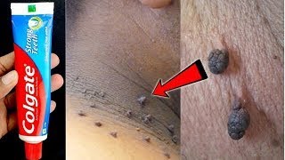REMOVE SKIN TAGS OVERNIGHT WITH TOOTHPASTE | HOW TO REMOVE SKIN TAG | SKIN TAG REMOVAL