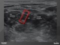 Webinar: Continuous Interscalene Cath. Placement Utilizing the "Hickman Flip"