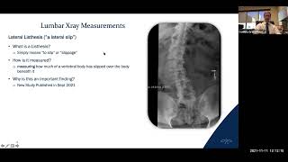 When should you have surgery for adult onset scoliosis?