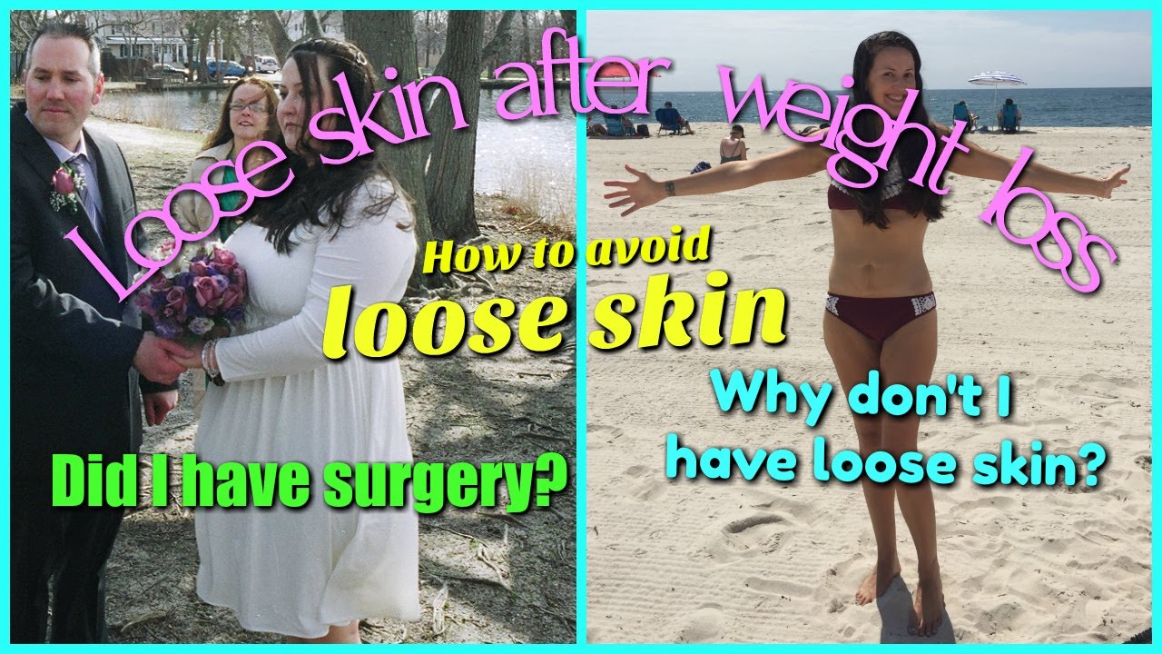 health insurance LOOSE SKIN AFTER WEIGHT LOSS / The Veggie Nut / Vlogmas Day 10