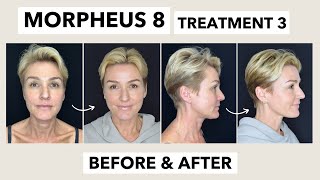 Datos Morpheus 8 Third Treatment  // Non Surgical Facelift // Before and After Treatment 3 Guía