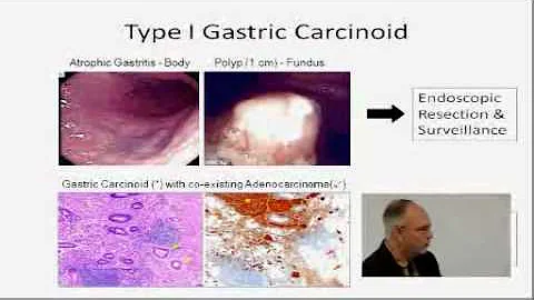 Surgical Management of Neuroendocrine Tumors of th...