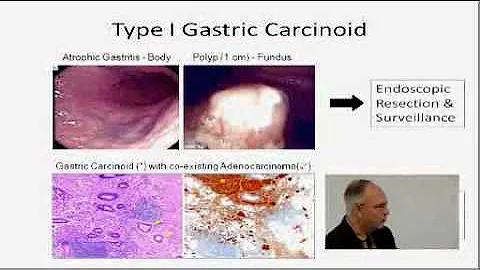 Surgical Management of Neuroendocrine Tumors of the GI Tract - Dr. Jeffrey Norton
