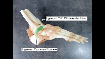 Comment soigner une rupture du ligament Talo-fibulaire ?