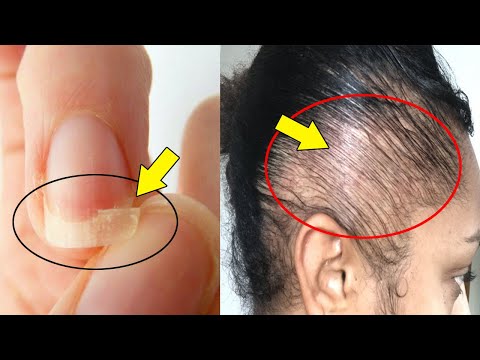 The Benefits &amp; Side Effects of Biotin for Hair Growth, Skin &amp; Nails! Glowing Skin &amp; GROW Nails FAST
