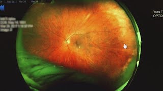 Eye doctors urging caution about potential risks of GLP-1s