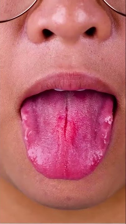 How Do You Fix A Burnt Tongue How To Fix Burnt Tongue At Home #shorts #burnttongue #homeremedies #