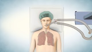 Lung Transplant Process