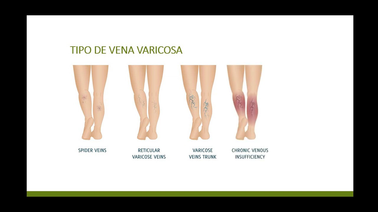 ginger varicoza