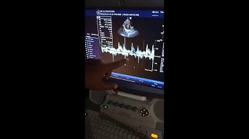 GE Logiq P5 - Performing scans with 3S Cardiac probe