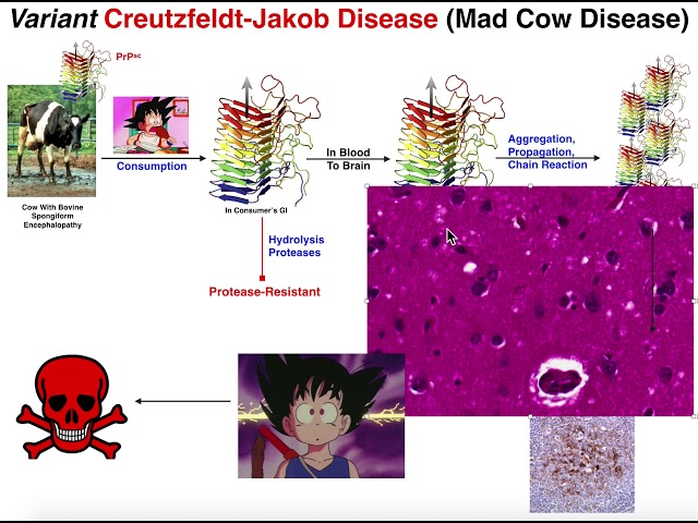 Prions | Mad Cow Disease & Variant Creutzfeldt-Jakob Disease (vCJD) -  YouTube