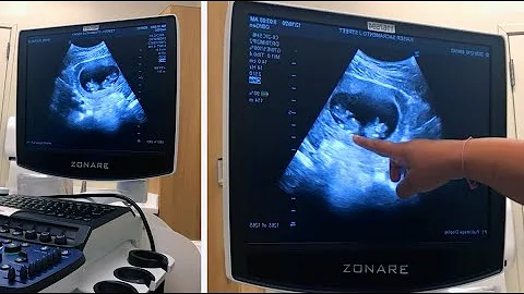 SURPRISE ULTRASOUND... TWINS!? | Twins on Ultrasou...