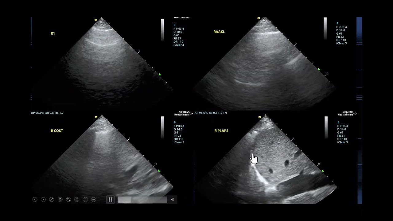 Mayo Clinic Minute: What is cardiogenic shock?