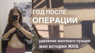 МОЯ ИСТОРИЯ ЖКБ | ЖИЗНЬ ПОСЛЕ ОПЕРАЦИИ | БЕЗ ЖЕЛЧНОГО ПУЗЫРЯ