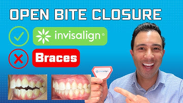 Correcting (Lateral) Open Bites With Invisalign (NEW METHOD)
