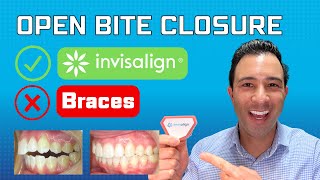 Correcting (Lateral) Open Bites With Invisalign (NEW METHOD)