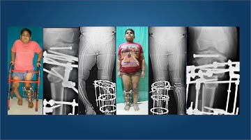 Surgical Tools for Deformity Correction: ilizarov & beyond